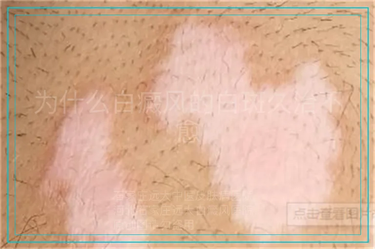 为什么白癜风的白斑久治不愈