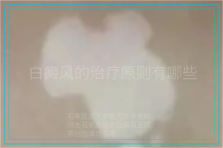 白癜风的治疗原则有哪些