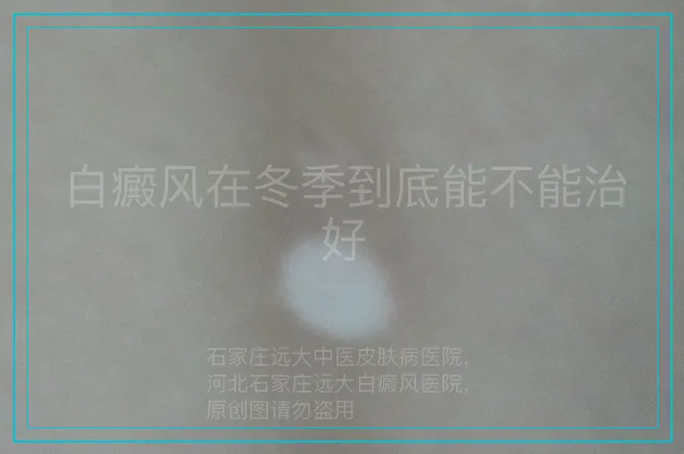 白癜风在冬季到底能不能治好