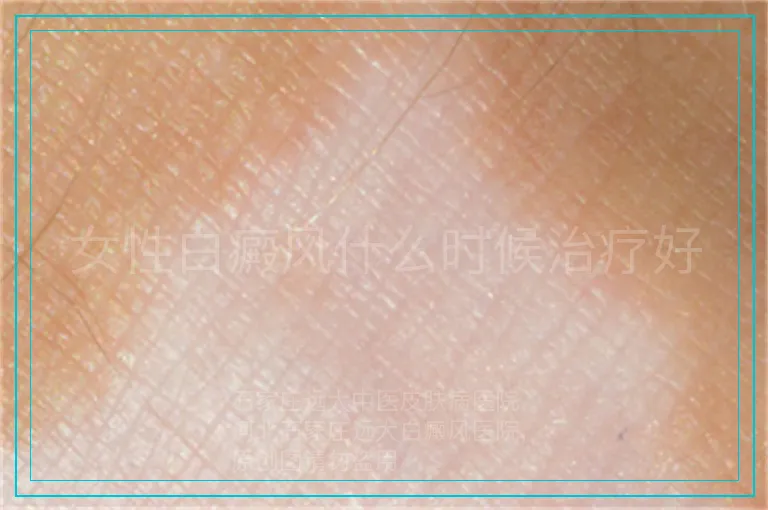 女性白癜风什么时候治疗好