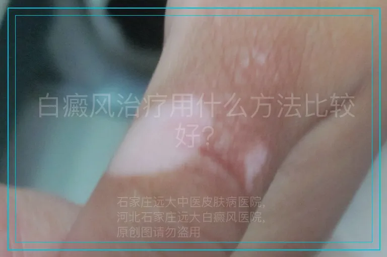 白癜风治疗用什么方法比较好?