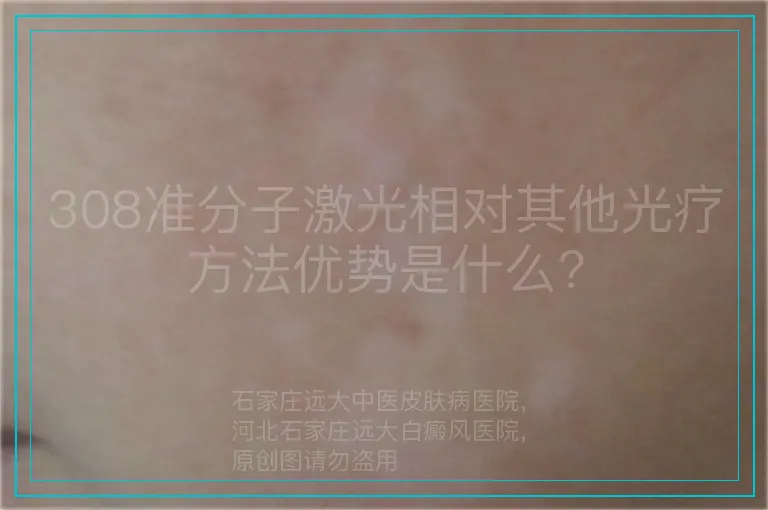 308准分子激光相对其他光疗方法优势是什么?