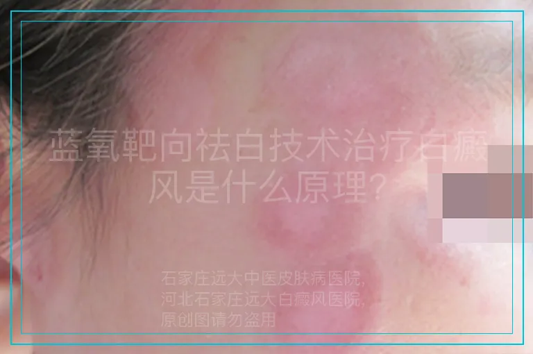 蓝氧靶向祛白技术治疗白癜风是什么原理?