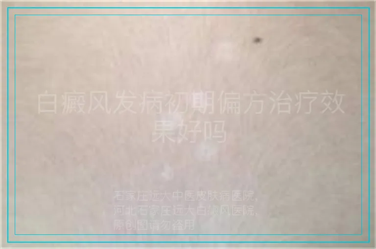 白癜风发病初期偏方治疗效果好吗