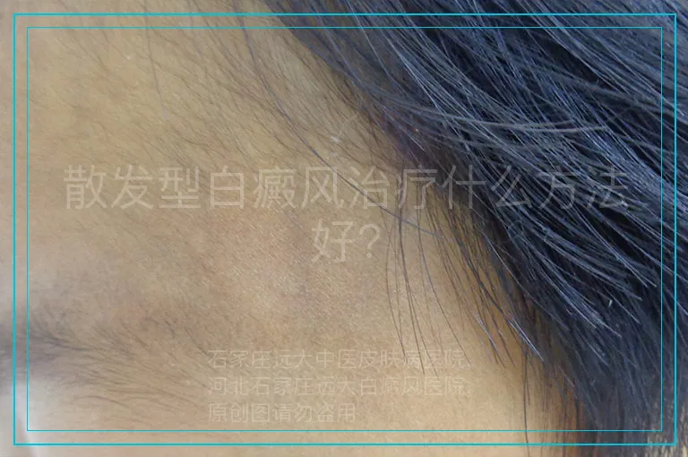 散发型白癜风治疗什么方法好?