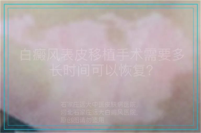 白癜风表皮移植手术需要多长时间可以恢复?