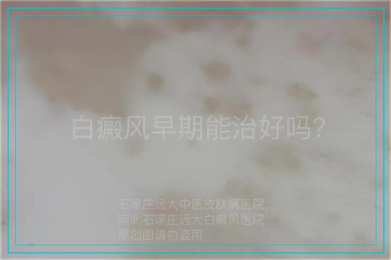 白癜风早期能治好吗？