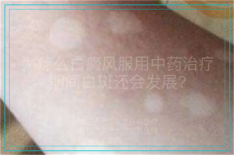 为什么白癜风服用中药治疗期间白斑还会发展?