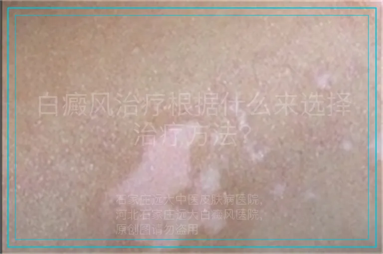 白癜风治疗根据什么来选择治疗方法?