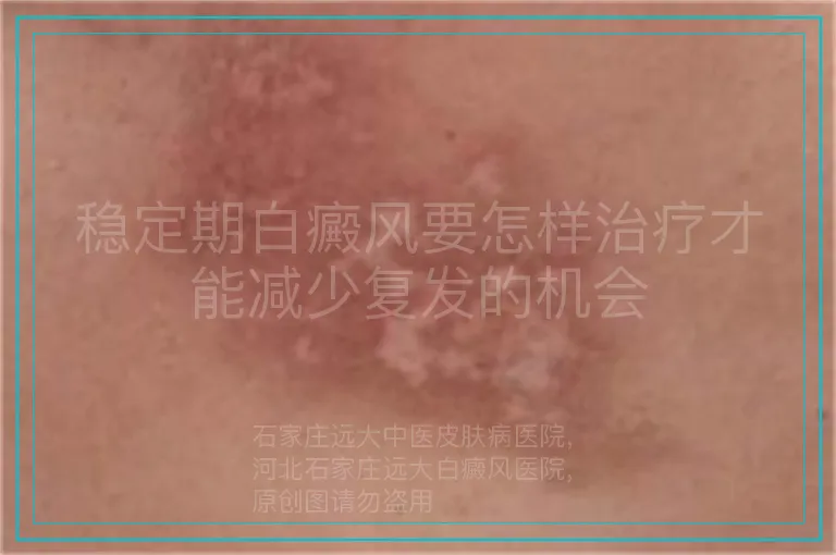 稳定期白癜风要怎样治疗才能减少复发的机会