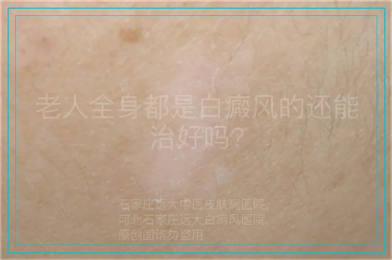 老人全身都是白癜风的还能治好吗?