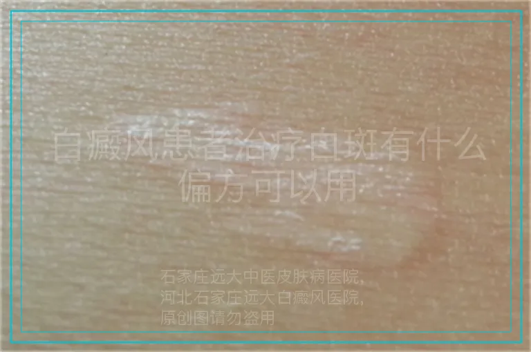 白癜风患者治疗白斑有什么偏方可以用