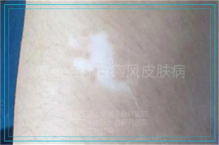 怎么治疗白癜风皮肤病