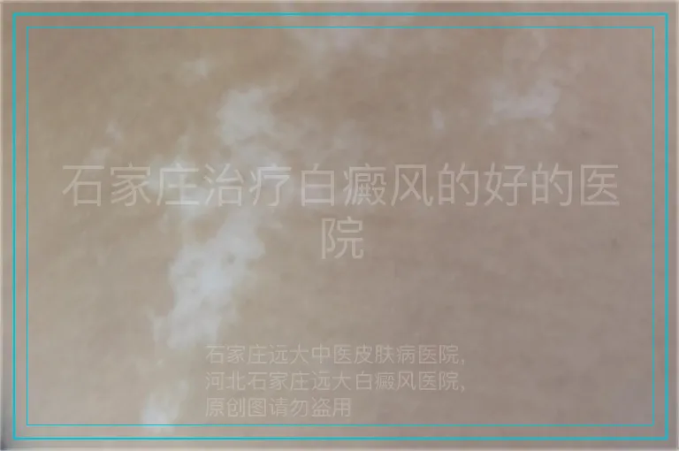石家庄治疗白癜风的好的医院
