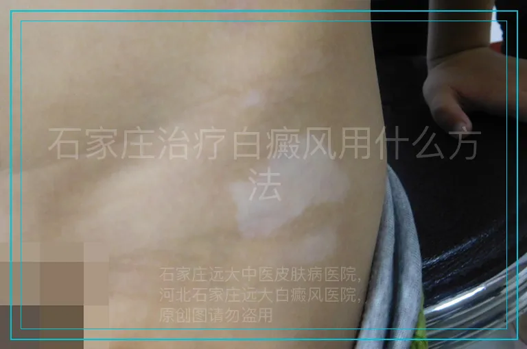 石家庄治疗白癜风用什么方法
