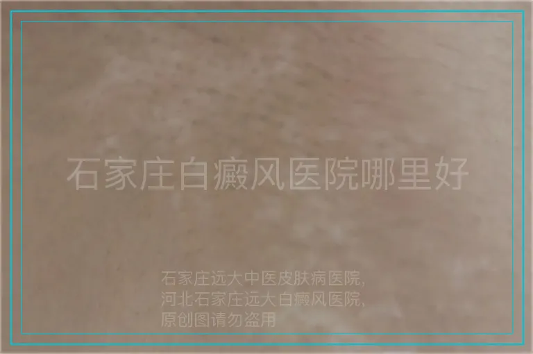 石家庄白癜风医院哪里好