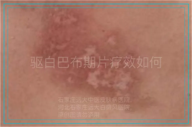 驱白巴布期片疗效如何
