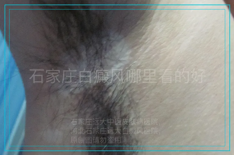 石家庄白癜风哪里看的好