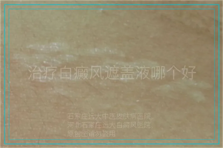 治疗白癜风遮盖液哪个好