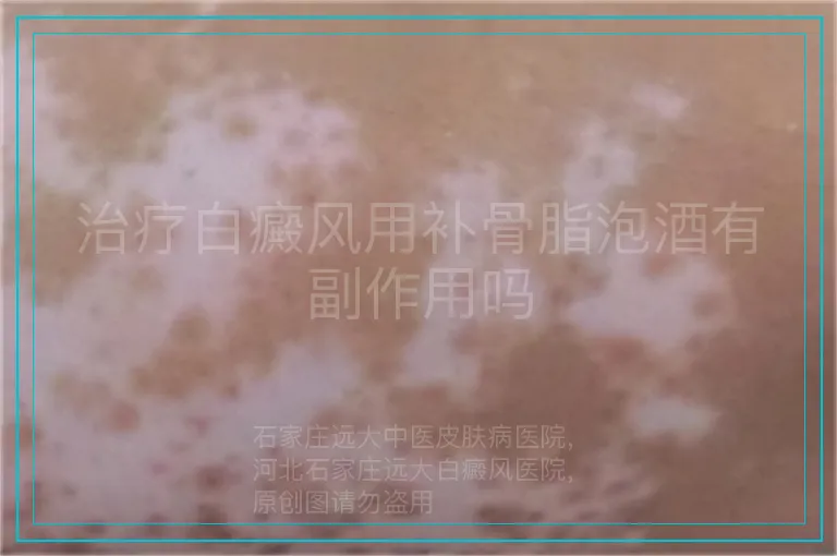 治疗白癜风用补骨脂泡酒有副作用吗