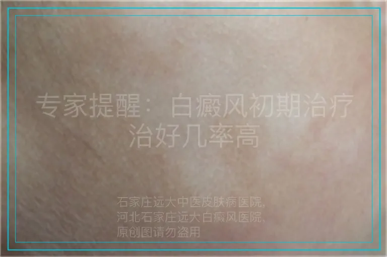 专家提醒:白癜风初期治疗治好几率高