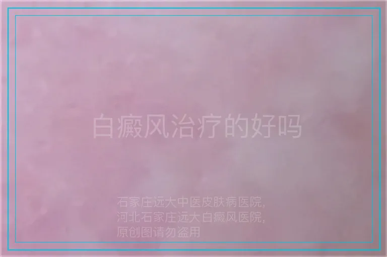 白癜风治疗的好吗