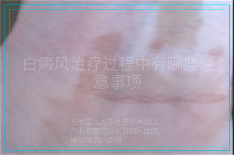 白癜风治疗过程中有哪些注意事项
