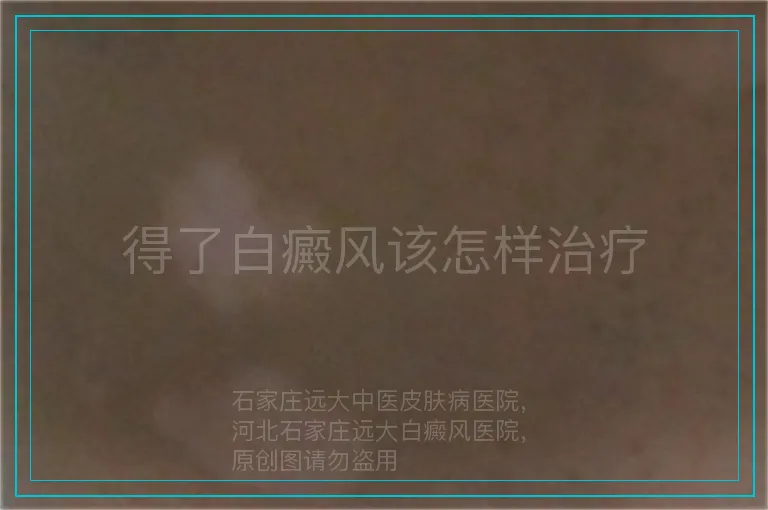 得了白癜风该怎样治疗