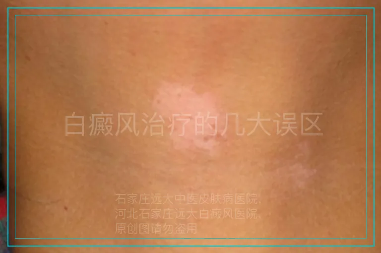 白癜风治疗的几大误区