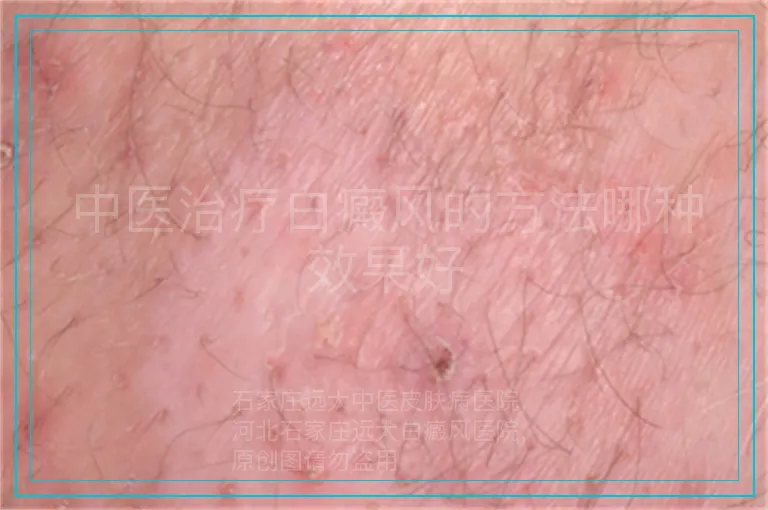 中医治疗白癜风的方法哪种效果好