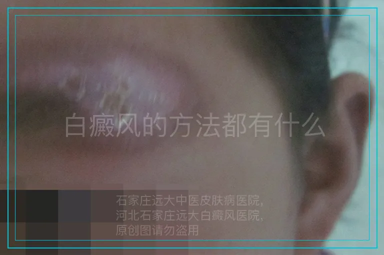 白癜风的方法都有什么