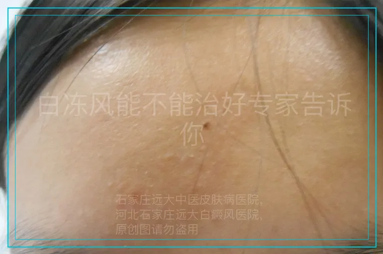 白冻风能不能治好专家告诉你