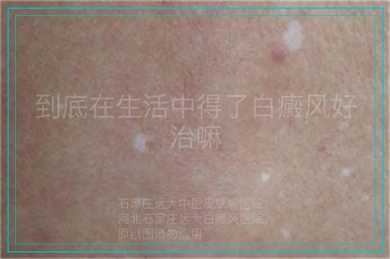 到底在生活中得了白癜风好治嘛