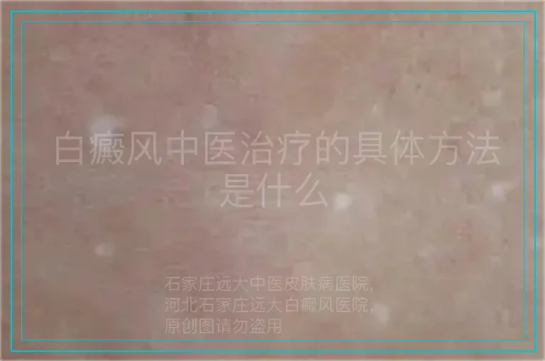 白癜风中医治疗的具体方法是什么