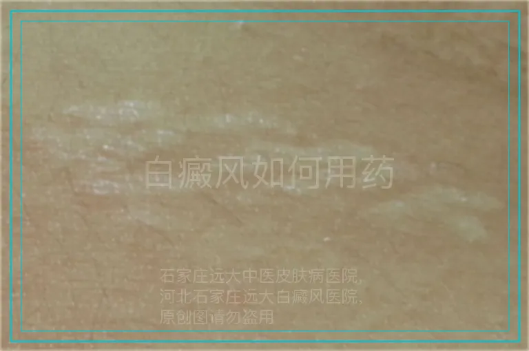 白癜风如何用药