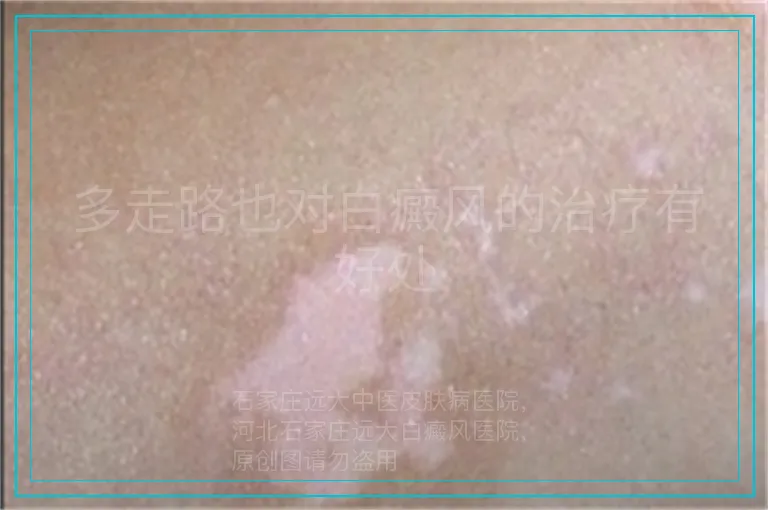 多走路也对白癜风的治疗有好处