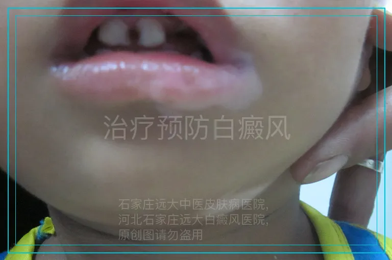 治疗预防白癜风
