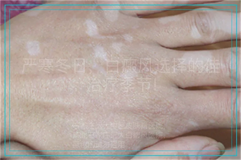 严寒冬日,白癜风选择的佳治疗季节!