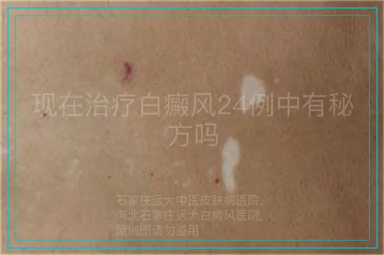 现在治疗白癜风24例中有秘方吗