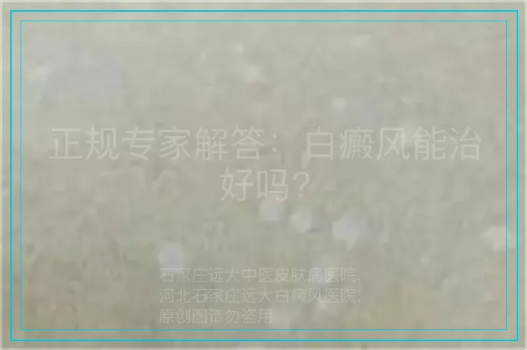 正规专家解答:白癜风能治好吗?