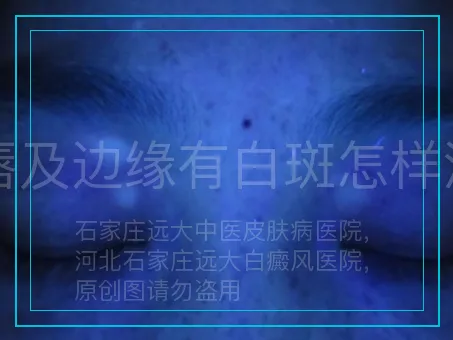 嘴唇及边缘有白斑怎样治疗