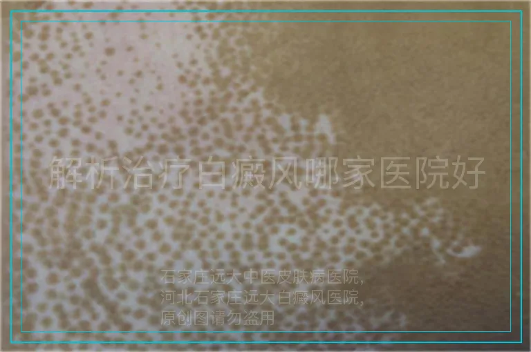 解析治疗白癜风哪家医院好
