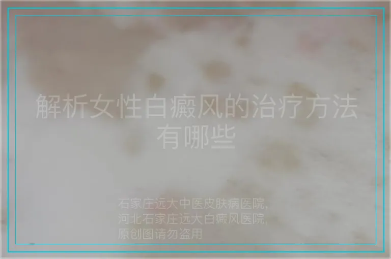 解析女性白癜风的治疗方法有哪些