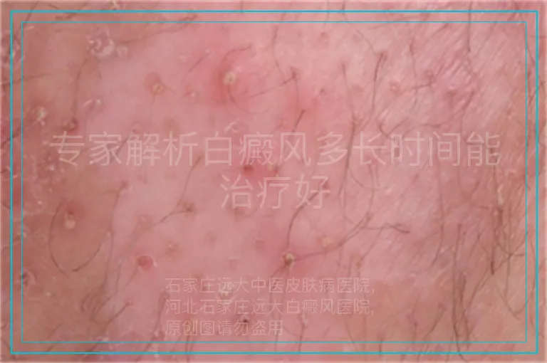专家解析白癜风多长时间能治疗好