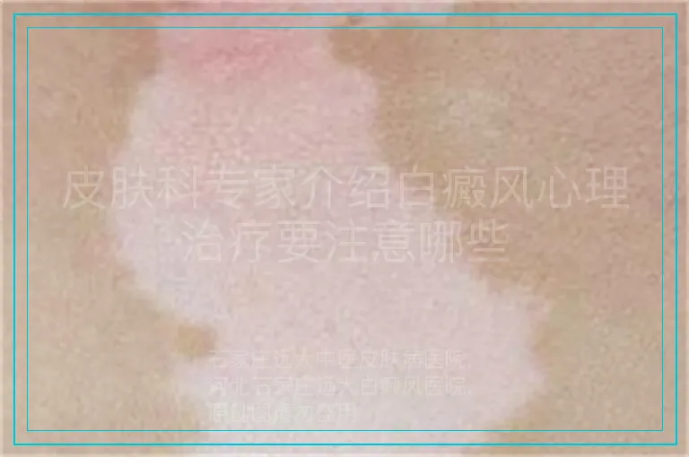 皮肤科专家介绍白癜风心理治疗要注意哪些