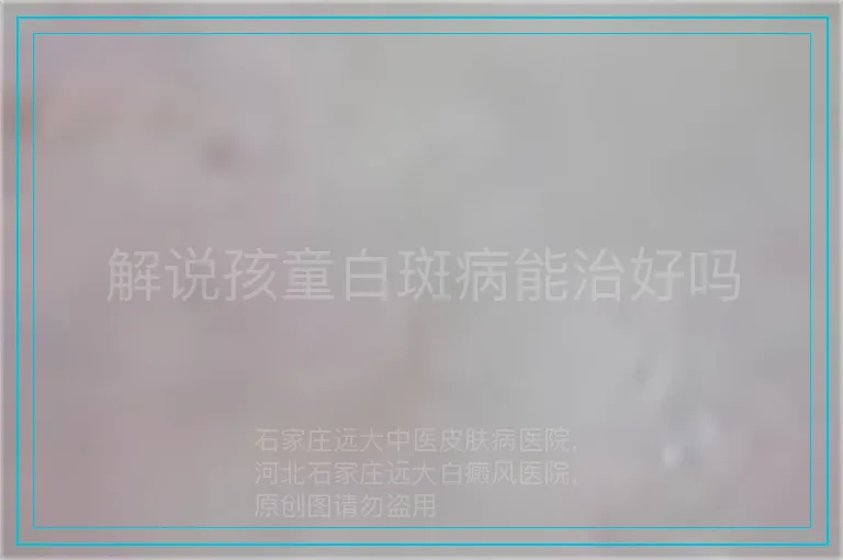 解说孩童白斑病能治好吗