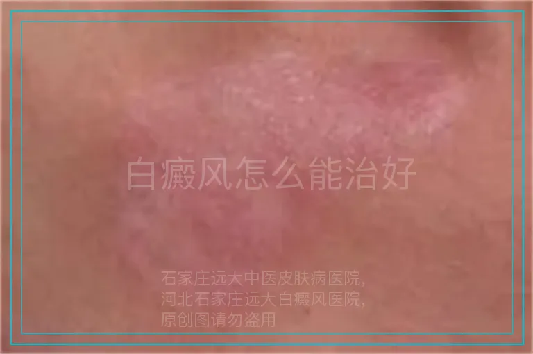 白癜风怎么能治好