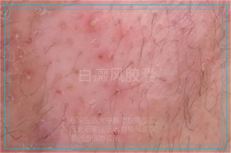 白癜风胶囊
