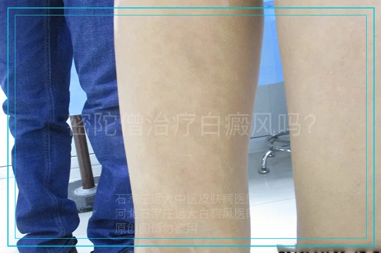 密陀僧治疗白癜风吗?