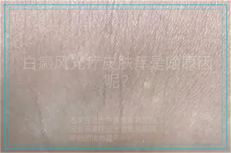 白癜风光疗皮肤痒是啥原因呢?